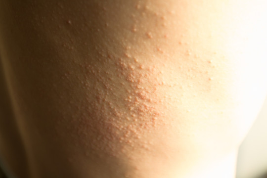 皮肤病 荨麻疹 肢体病状