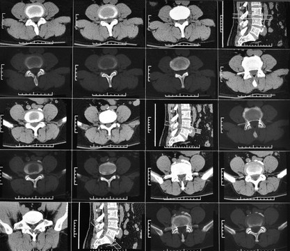 腰椎CT扫描片