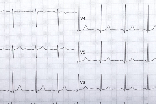 心电图