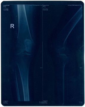 膝关节半月板照影