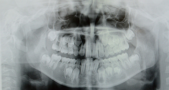 口腔牙片