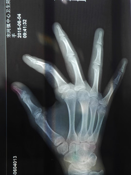 手掌X光图片