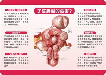 妇产科子宫肌瘤的危害