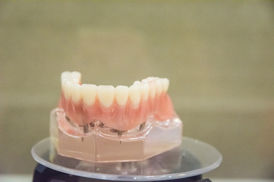 牙齿种植技术模型
