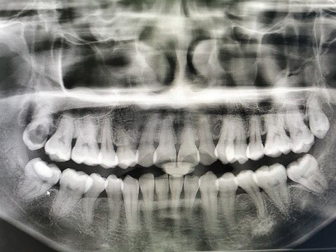 口腔科牙科X照片