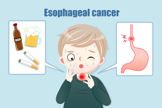 長輩罹患食道癌起因插圖
