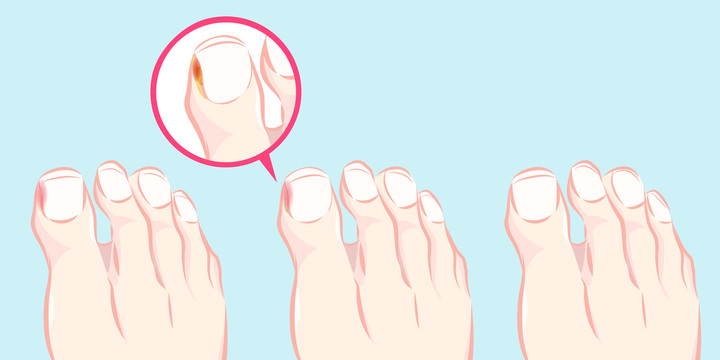 腳拇指甲溝發(fā)炎插圖
