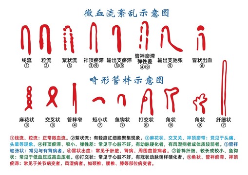 微血流紊乱和畸形管示意图