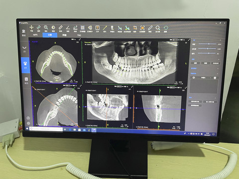牙齿CT