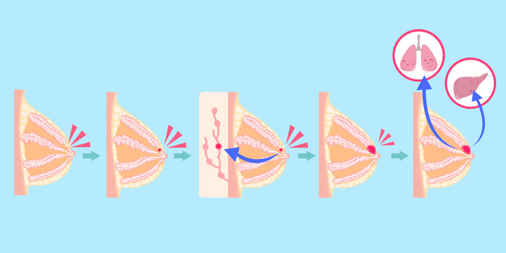 卡通乳腺癌胸部剖面癌症转移插图