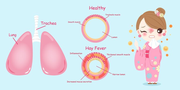 花粉症的女性 健康及发炎的角膜插图