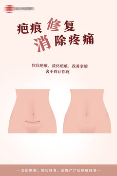 女性产后疤痕修复