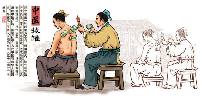 中醫(yī)拔罐插畫