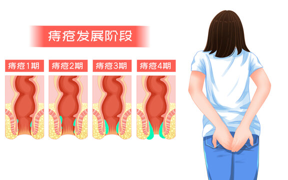 醫(yī)療健康痔瘡疼痛科普插畫