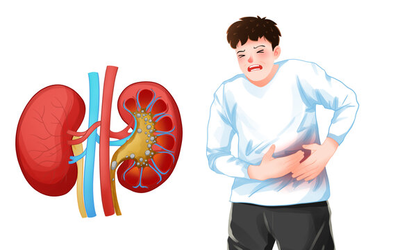 醫(yī)療健康腎結(jié)石肚子疼的男人插畫