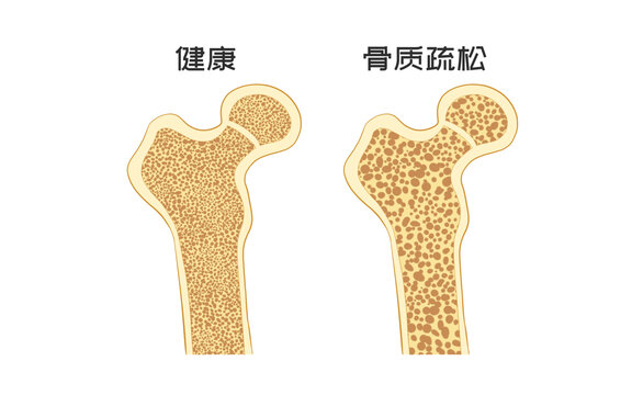 醫(yī)療健康骨質(zhì)疏松科普插畫