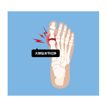 痛風(fēng)