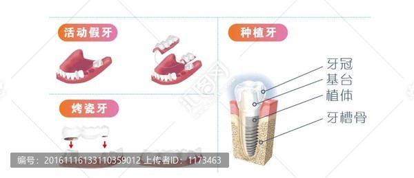 活動假,牙烤瓷,牙種植牙