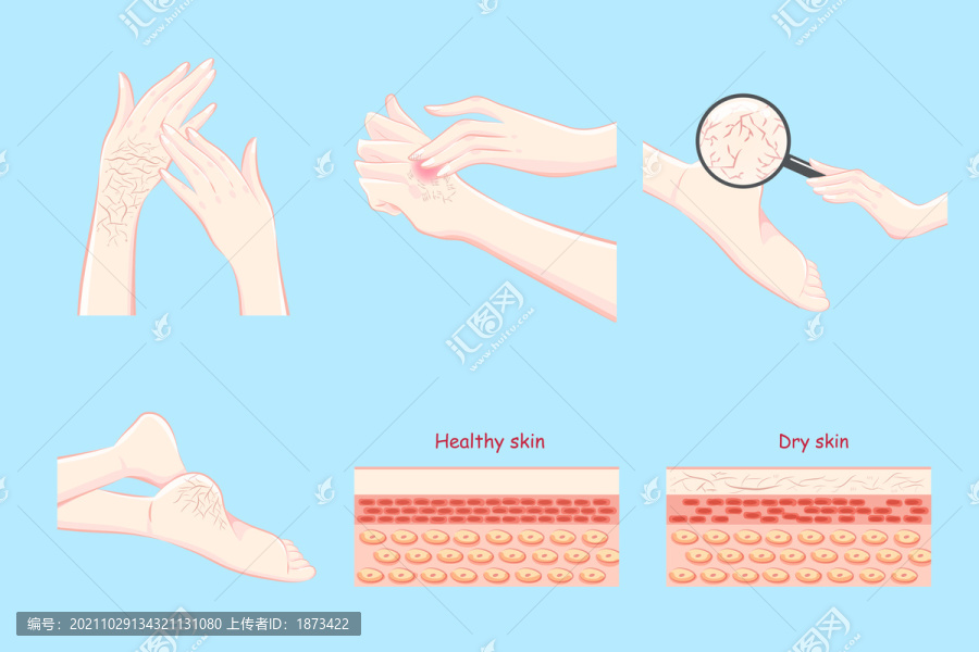 手脚角质粗厚,皮质层插图