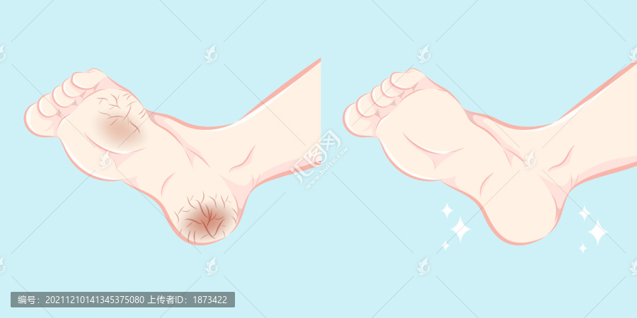 腳掌龜裂粗腳皮改善插圖