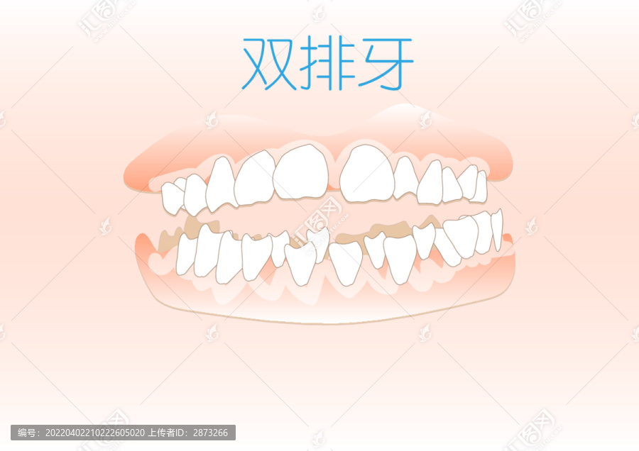 双排牙畸形牙