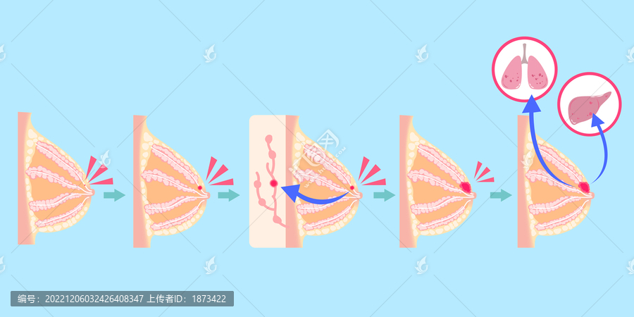 卡通乳腺癌胸部剖面癌症转移插图