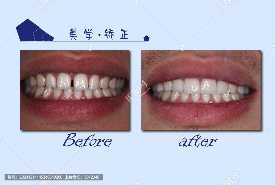 矯正前后對比