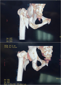 髋关节CT扫描3D图像