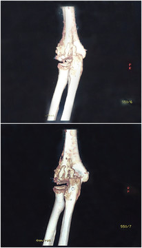 肘关节CT扫描3D图像