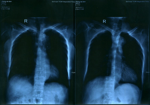 胸脊柱照片