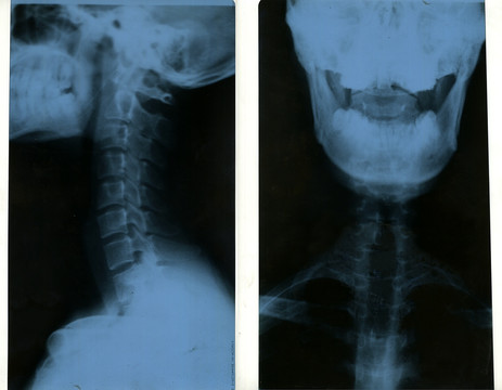 颈椎正侧面x光片