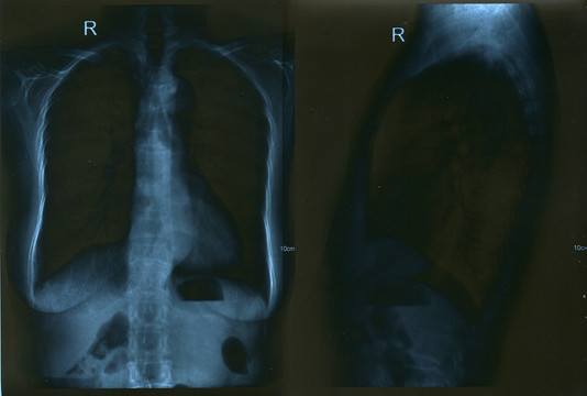胸部正侧位x光片