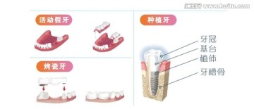 活动假 牙烤瓷 牙种植牙