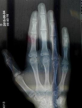 X光手骨骼