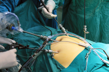 腹腔镜手术