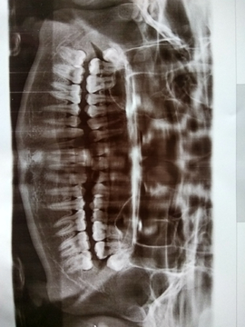 牙齿的X光片