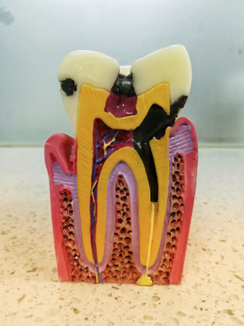 牙齿标本坏牙模型