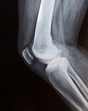 人体右腿膝盖部位X光透视照片