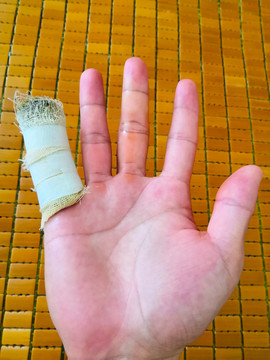 尾指治疗
