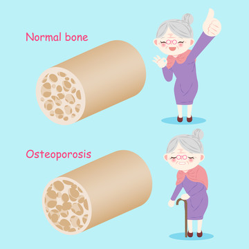 女性老年人骨骼健康插图