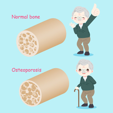 男性老年人骨骼健康插图
