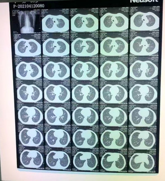 X光片