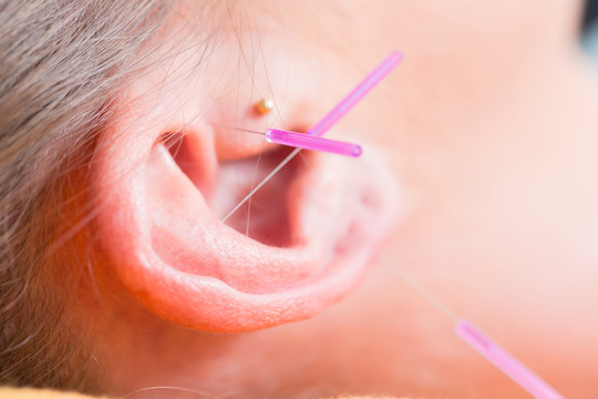 在替代疗法中使用针灸针的妇女的耳朵