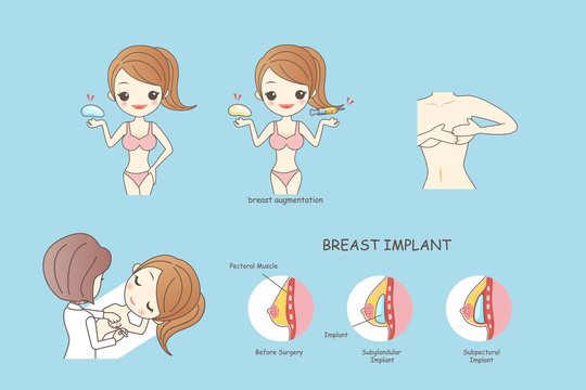 隆胸的手术过程讲解插图合集