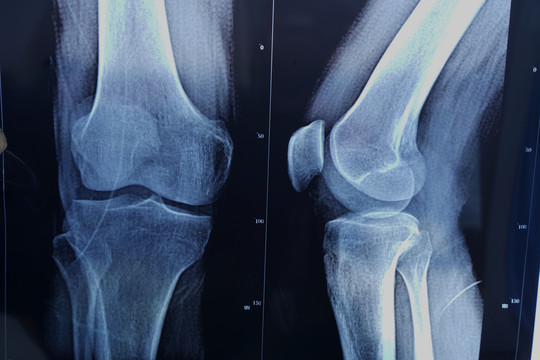 膝盖X光拍片