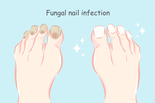 霉菌感染脚指甲对比插图