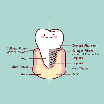 牙齿植牙剖面插图