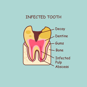 感染病变牙齿剖面插图