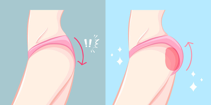 女性臀部侧面 提臀手术对照插图