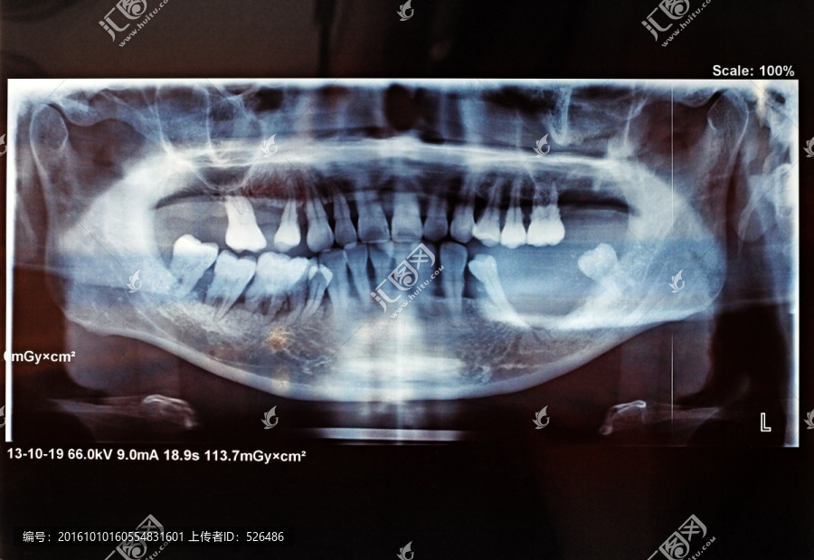 X光线,牙齿片